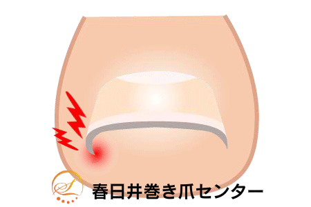 巻き爪矯正の図解